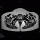 Osteolytic changes of femur: MRI - Magnetic Resonance Imaging